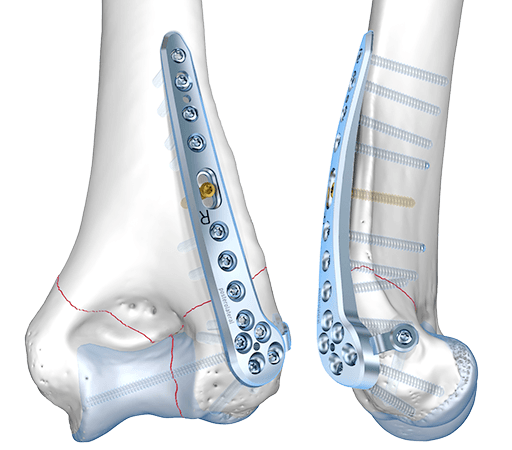 Sistema de húmero distal 2.8