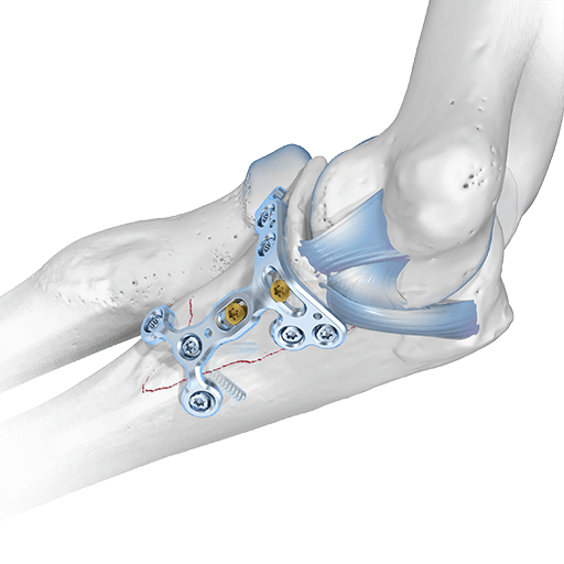 Placas de coronoides 2.0