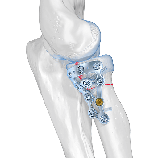 Sistema de cabeza del radio 2.0